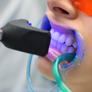 Laser-Teeth-Whitening-home
